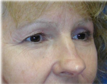 Upper Blepharoplasty Before & After Patient #130