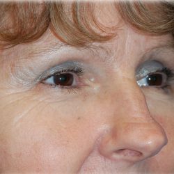 Upper Blepharoplasty Before & After Patient #130