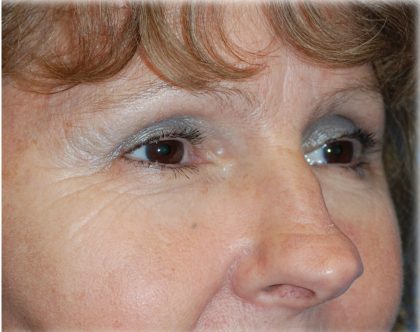 Upper Blepharoplasty Before & After Patient #130