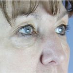 Upper Blepharoplasty Before & After Patient #131