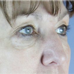 Upper Blepharoplasty Before & After Patient #131