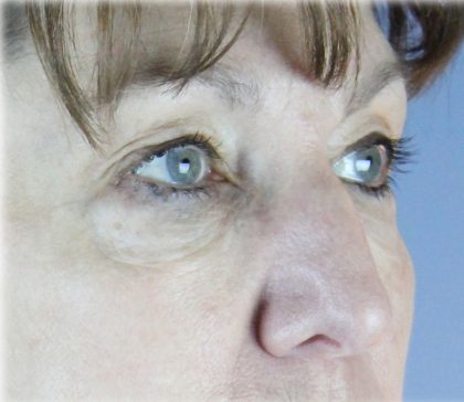 Upper Blepharoplasty Before & After Patient #131
