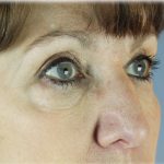 Upper Blepharoplasty Before & After Patient #131