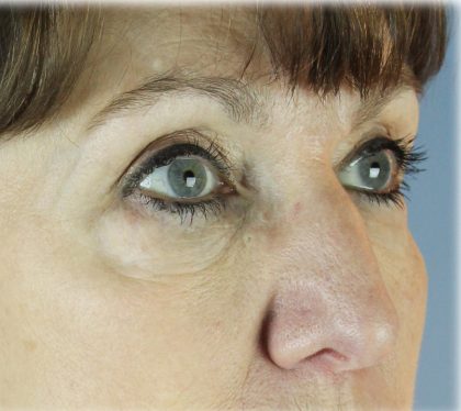 Upper Blepharoplasty Before & After Patient #131