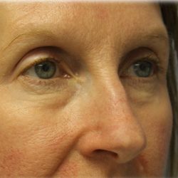 Lower Blepharoplasty Before & After Patient #132