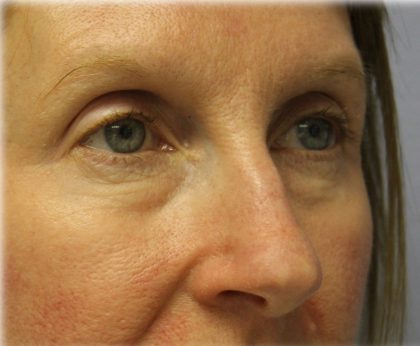 Lower Blepharoplasty Before & After Patient #132