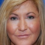 Cheek Augmentation Before & After Patient #77
