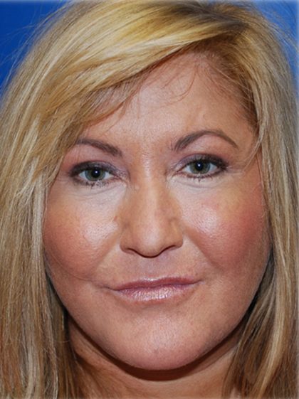 Cheek Augmentation Before & After Patient #77