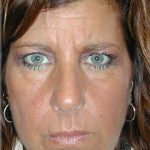 Brow Lift Before & After Patient #65