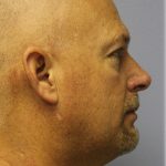 Chin Augmentation Before & After Patient #98
