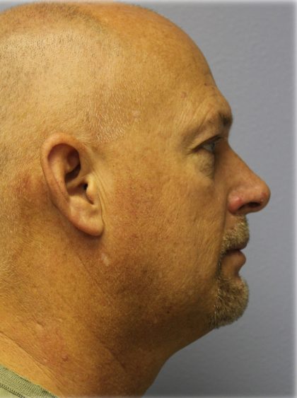 Chin Augmentation Before & After Patient #98