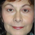 Quad Blepharoplasty Before & After Patient #121