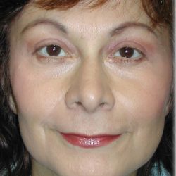 Quad Blepharoplasty Before & After Patient #121