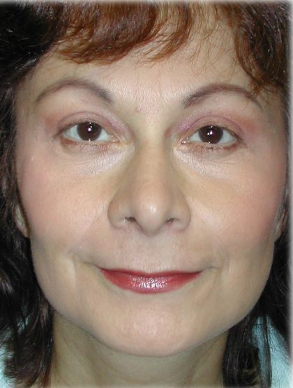 Quad Blepharoplasty Before & After Patient #121