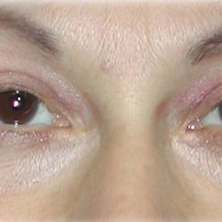 Quad Blepharoplasty Before & After Patient #122