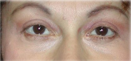 Quad Blepharoplasty Before & After Patient #122