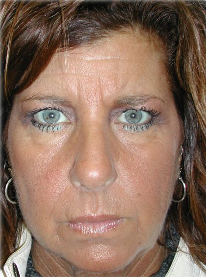 Brow Lift Before & After Patient #65