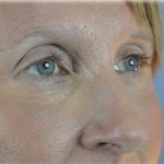 Lower Blepharoplasty Before & After Patient #132