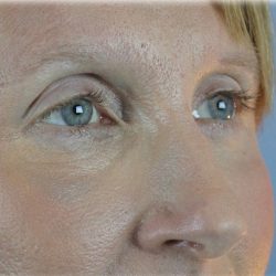 Lower Blepharoplasty Before & After Patient #132