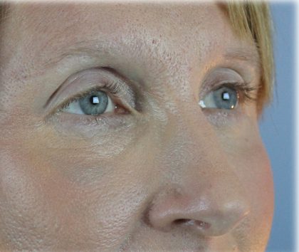 Lower Blepharoplasty Before & After Patient #132
