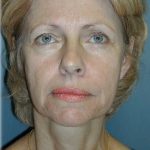 Cheek Augmentation Before & After Patient #82