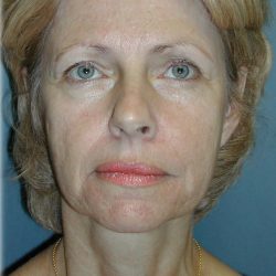 Cheek Augmentation Before & After Patient #82