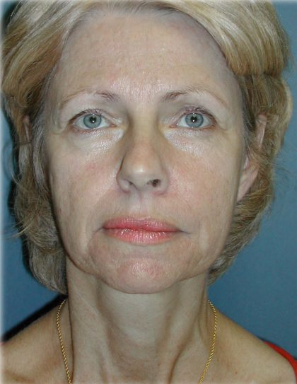 Cheek Augmentation Before & After Patient #82