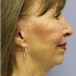 Chin Augmentation Before & After Patient #97