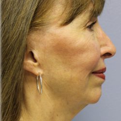 Chin Augmentation Before & After Patient #97