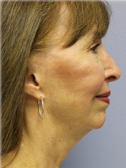 Chin Augmentation Before & After Patient #97