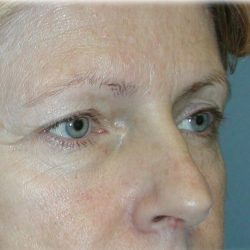 Brow Lift Before & After Patient #74