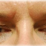 Upper Blepharoplasty Before & After Patient #120
