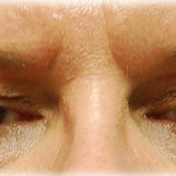Upper Blepharoplasty Before & After Patient #120