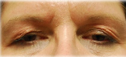 Upper Blepharoplasty Before & After Patient #120