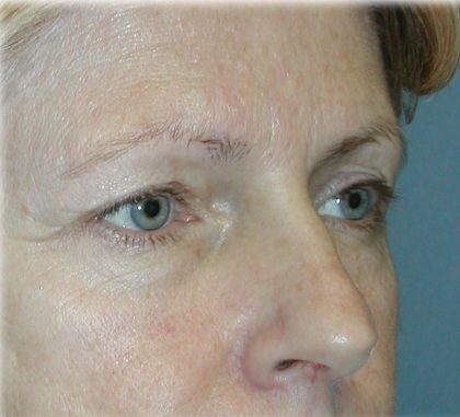 Brow Lift Before & After Patient #74