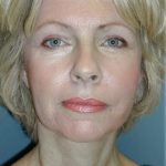 Cheek Augmentation Before & After Patient #82