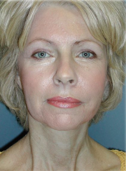Cheek Augmentation Before & After Patient #82