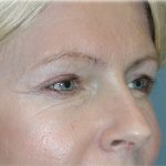 Brow Lift Before & After Patient #74