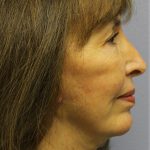 Chin Augmentation Before & After Patient #97