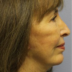 Chin Augmentation Before & After Patient #97