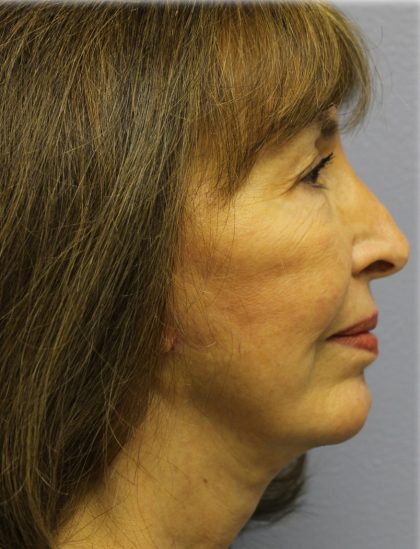 Chin Augmentation Before & After Patient #97