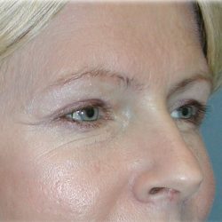 Brow Lift Before & After Patient #74