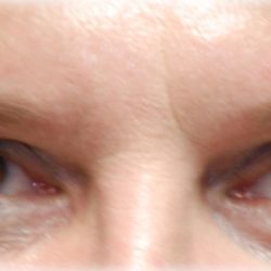 Upper Blepharoplasty Before & After Patient #120