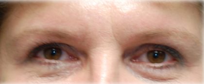 Upper Blepharoplasty Before & After Patient #120