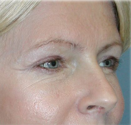 Brow Lift Before & After Patient #74