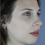 Chin Augmentation Before & After Patient #96