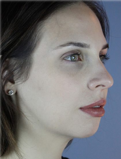 Chin Augmentation Before & After Patient #96