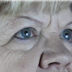 Brow Lift Before & After Patient #75
