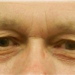 Upper Blepharoplasty Before & After Patient #125