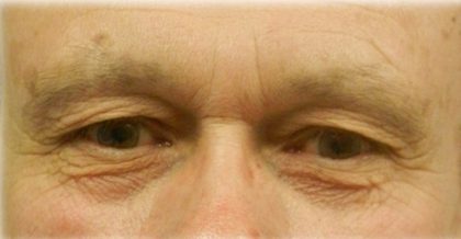 Upper Blepharoplasty Before & After Patient #125